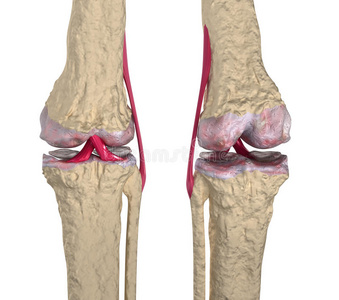 骨关节炎带韧带和关节车的膝关节