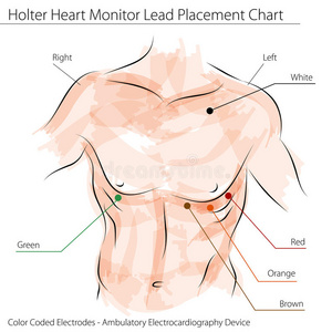 holter心脏监护仪导联放置图