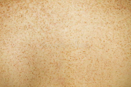 雀斑背部皮肤图片