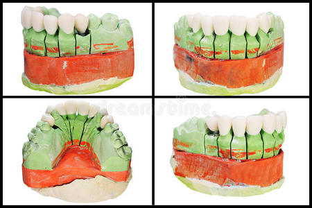 牙修复模型拼贴