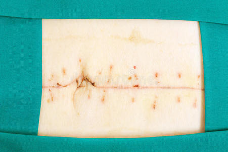 手术结痂外科手术照片