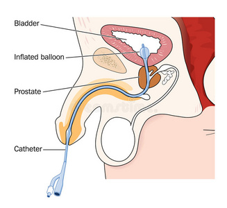 男性尿尿导尿管置入男性膀胱照片