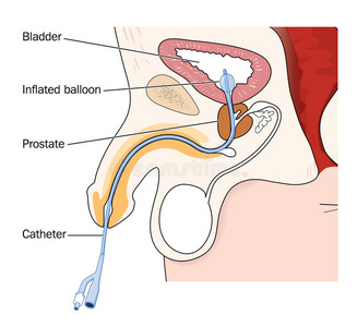 男性尿道 插管图片