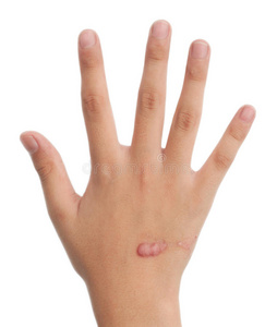 有伤疤的孩子的手照片