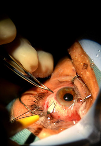 眼睛手术,特写.照片