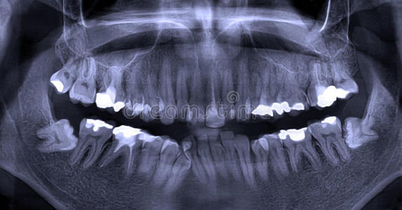 片智慧牙科x光片照片