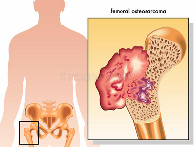 股骨marka股骨骨肉瘤照片