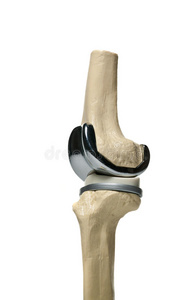 人膝关节修复术
