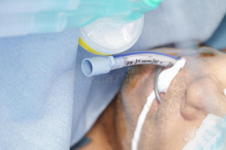 气管插管中吸痰的应用与气管插管中恢复的人喉镜和气管插管袖套式气管