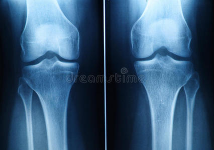 膝关节x光片照片