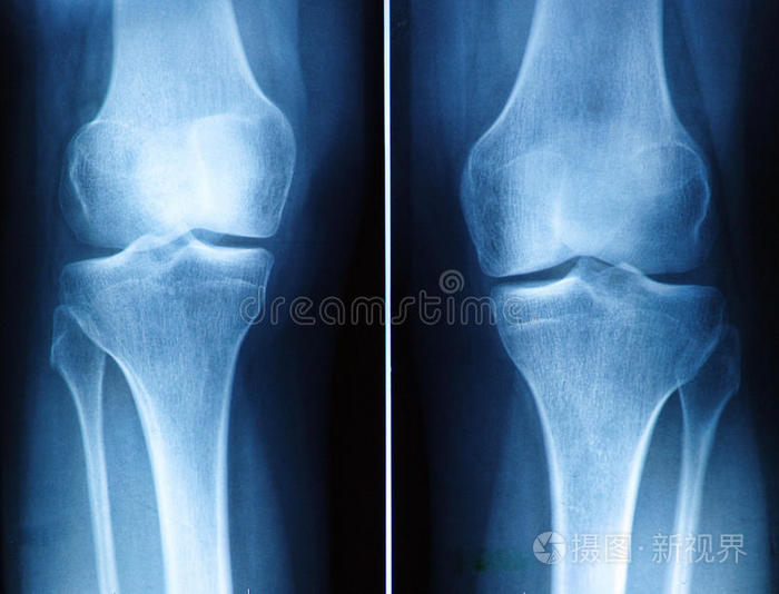 膝关节x光片