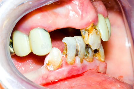 不健康的牙齿照片