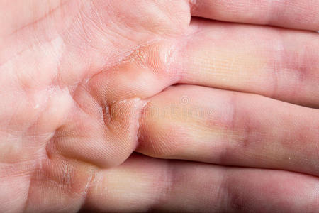 纱布包手的图片