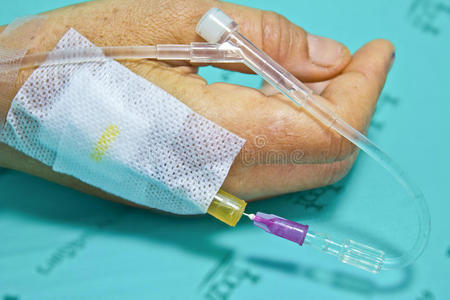 病人手上的静脉输液.照片