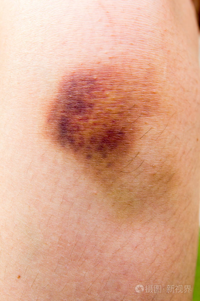 棕色的女人膝盖背景上的瘀伤