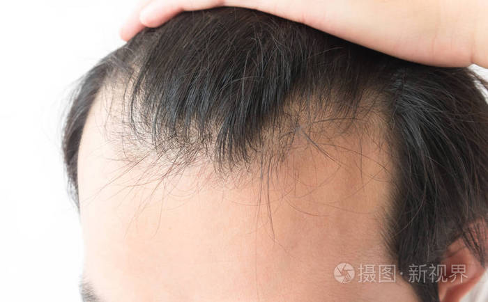 年轻男子严重脱发问题为卫生保健洗发水和美容产品概念