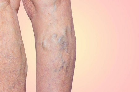 静脉曲张在腿上蓝色的老女人照片