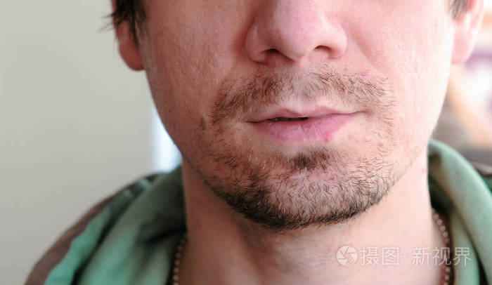 唇部治疗.亲密的男人嘴唇与疱疹.前视图