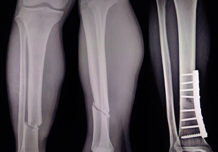 x 线腿3视图显示骨折与术后内固定. 太软和模糊的焦点图像