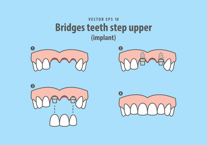 桥梁牙台阶上部 植入物 例证向量在蓝色 b