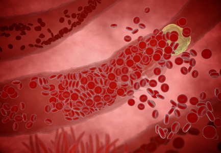 堵塞的动脉胆固醇斑块，概念 3d 动画