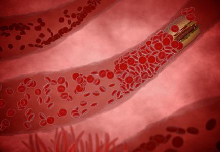 胆固醇堵塞动脉，医学概念与人体的血管堵塞由不健康饮食脂肪食物作为汉堡和油炸食品，作为肥胖或饮食和营养问题的健康风险