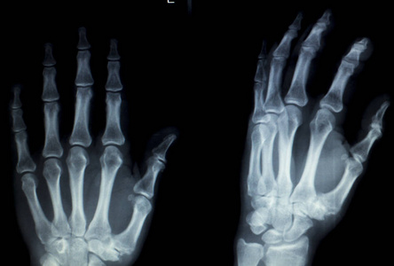 手的手指创伤性 x 射线扫描