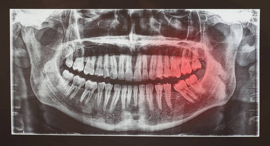 牙齿检查的医学放射学或放射治疗疼痛概念的红点