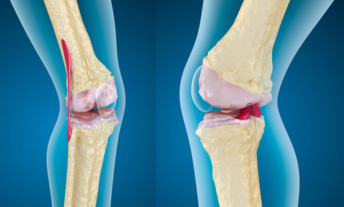骨质疏松症的膝盖关节