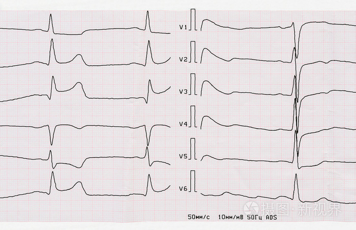 macrofocal后壁心肌梗塞急性期心电图