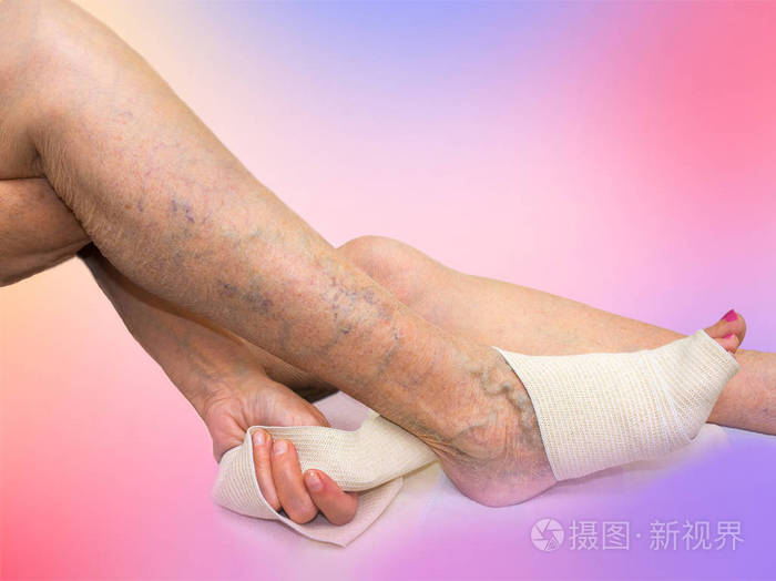 纠正了弹性绷带绑她的腿的女高管