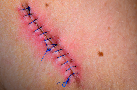 痣切除术后,伤口缝合照片