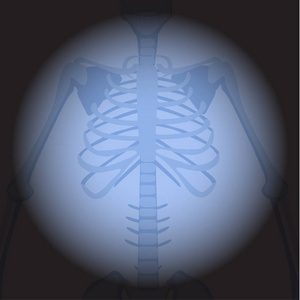 x 射线肋骨照片