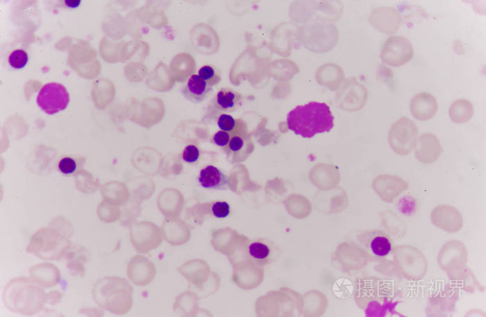 异常血红细胞