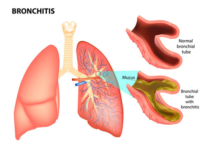 气管炎.正常支气管 andbronchial 管与支气管炎。支气管支气管炎部的矢量说明