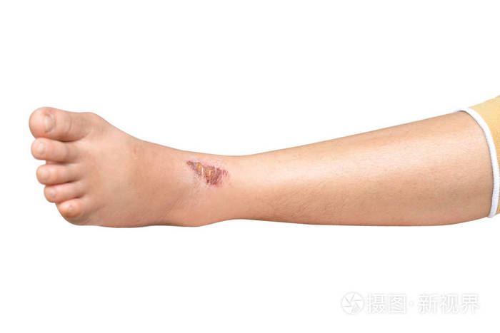 在白色背景上腿部的伤口