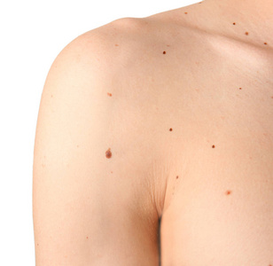 在人类身上的胎记照片