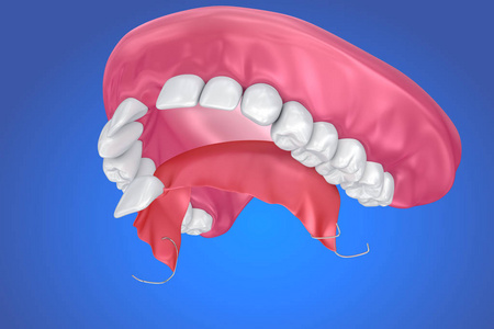 单缺失牙可摘局部义齿。3d 插图