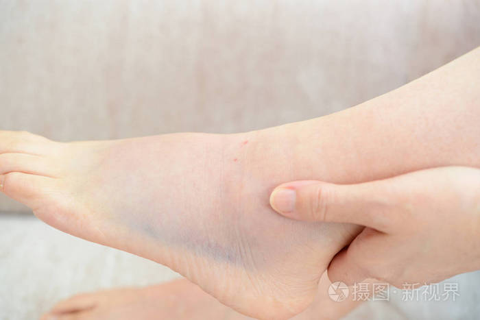 妇女举行痛苦扭伤脚踝