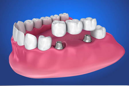 植入支承固定桥。医学上精确的3d 例证