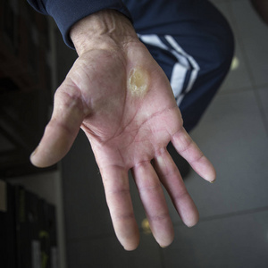 腿部的病变患水肿的病人腿部静脉的三大问题静脉疾病, 如蜘蛛静脉