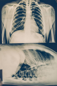 人体胸部或肺部放射摄影医疗技术和伦诊所诊断概念的 x 射线