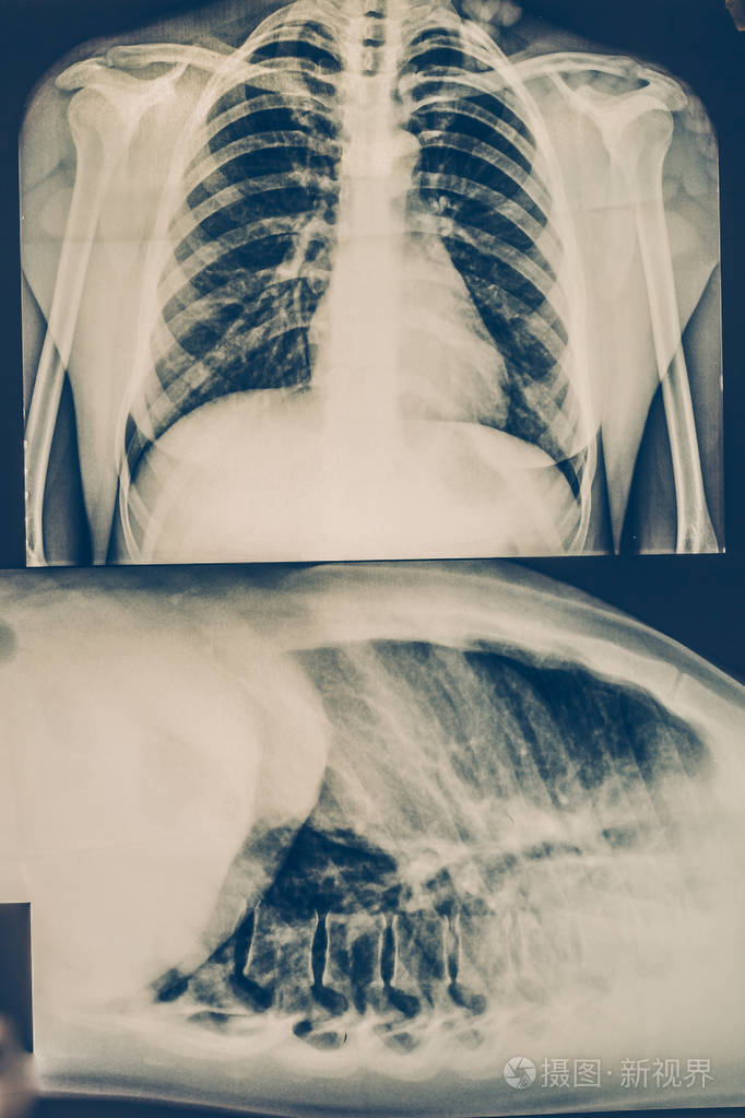 人体胸部或部放射摄影医疗技术和伦诊所诊断概念的x射线