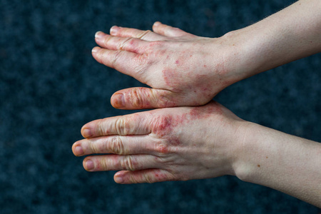 手与干燥和强调红色 dyshidrotic 湿疹皮肤清洁