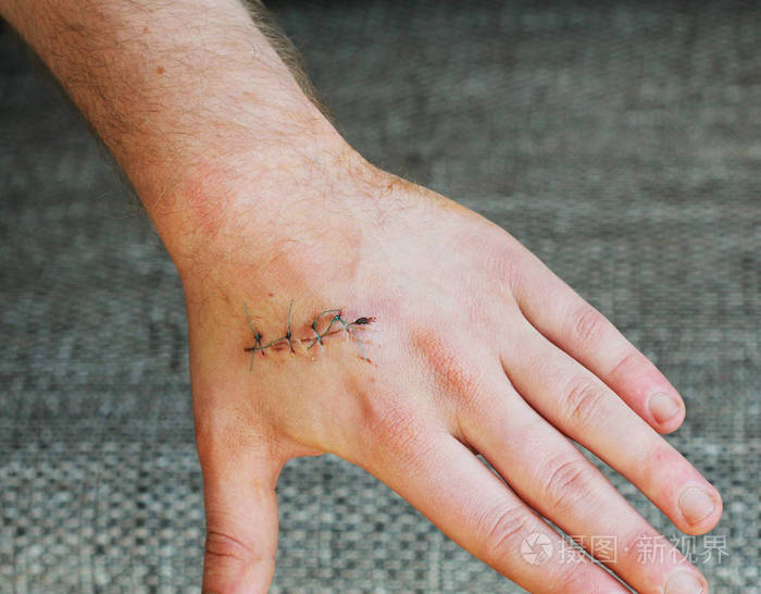 手在深色缝合伤口手上.事故概念的痛苦