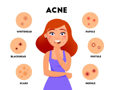 痤疮类型图表元素矢量平图。女孩脸上痤疮和不同的皮肤问题图标设置隔离在白色背景。治疗痤疮主题的概念图像
