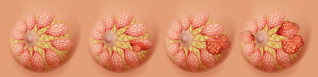 发展带粉红色丝带的女人用智能手机交谈, 在镜头上微笑, 在白色的乳房