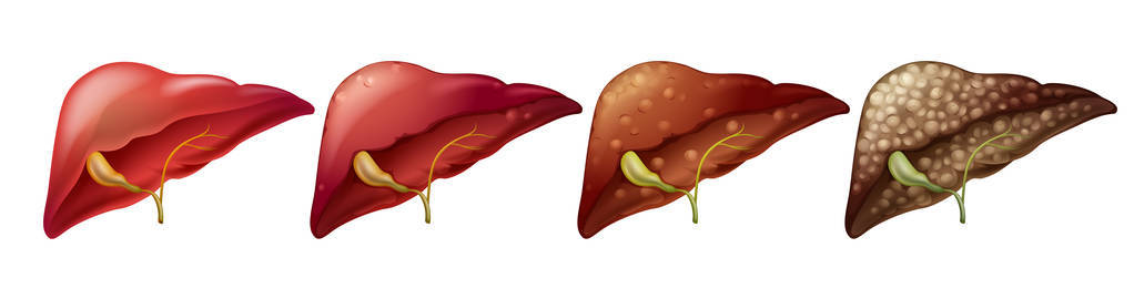 人类肝脏的不同阶段图片