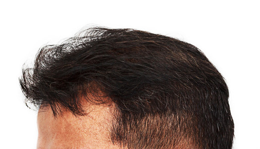 脱发和白发,头发损失症状男性头部正面照片