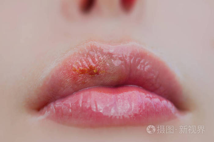 疱疹病毒病的女性嘴唇上 治疗的唇膏 传染性疾病 感染 患病期间女人的嘴巴 皮肤科医生诊治的疾病 女性嘴唇受疱疹 的特写照片 正版商用图片0nyowb 摄图新视界 疱疹病毒病的女性嘴唇上 治疗的唇膏 传染性疾病 感染 患病期间女人的嘴巴 皮肤科医生诊治的疾病 女性嘴唇受疱疹 的特写照片 正版商用图片0nyowb 摄图新视界